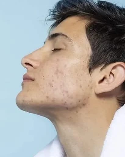 https://hypeready-admin-prod.s3.amazonaws.com/closebi-prod/Acne-Vulgaris-DCP44