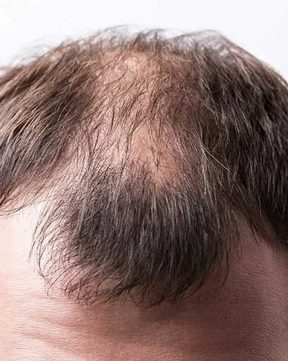 https://hypeready-admin-prod.s3.amazonaws.com/closebi-prod/Alopecia-DCP43