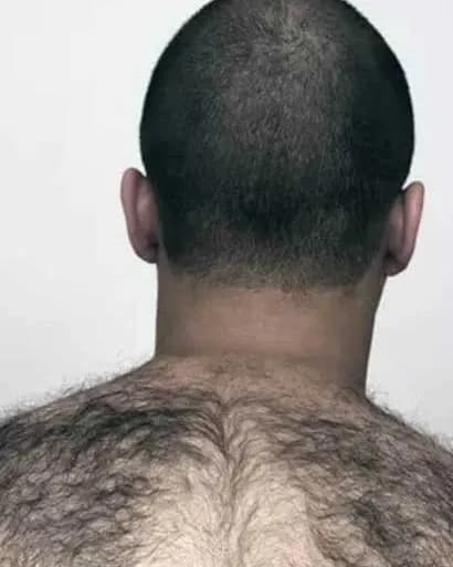 https://hypeready-admin-prod.s3.amazonaws.com/closebi-prod/Hypertrichosis-DCP49