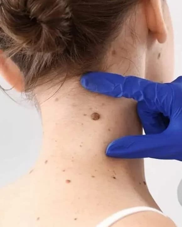 https://hypeready-admin-prod.s3.amazonaws.com/closebi-prod/Skin-Tag-Removal-Treatments-DCP39