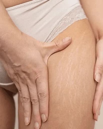 https://hypeready-admin-prod.s3.amazonaws.com/closebi-prod/Stretch-Marks-DCP54